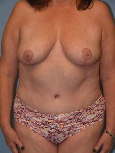 Mommy Makeover Gallery - Patient 92167436 - Image 2