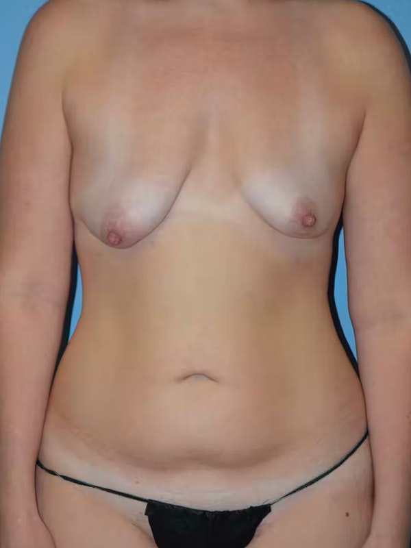 After Weight Loss Surgery Before & After Gallery - Patient 92151517 - Image 1
