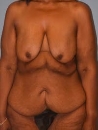 After Weight Loss Surgery Before & After Gallery - Patient 92151750 - Image 1