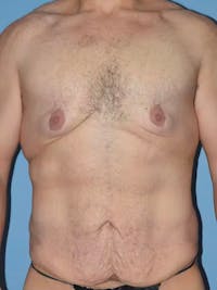 After Weight Loss Surgery Before & After Gallery - Patient 96421936 - Image 1