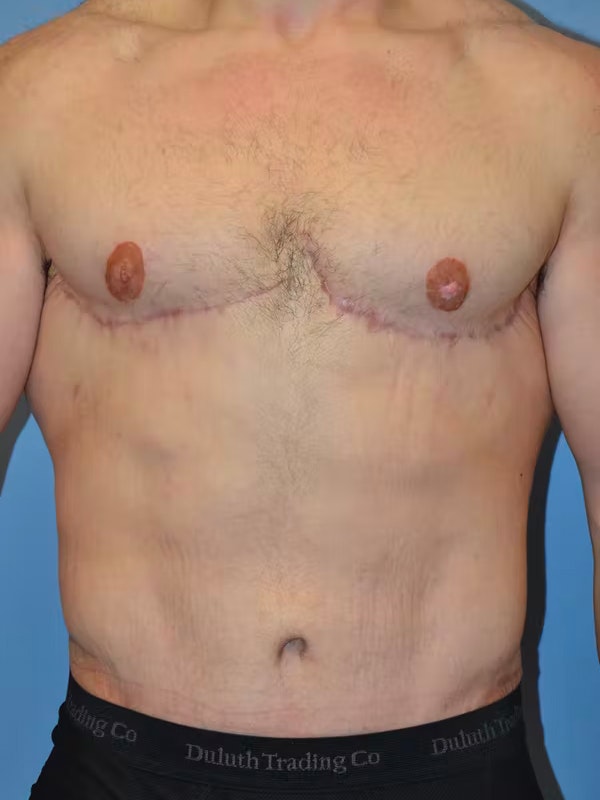 After Weight Loss Surgery Before & After Gallery - Patient 96421936 - Image 2