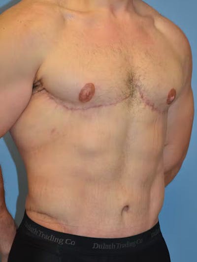 After Weight Loss Surgery Before & After Gallery - Patient 96421936 - Image 4