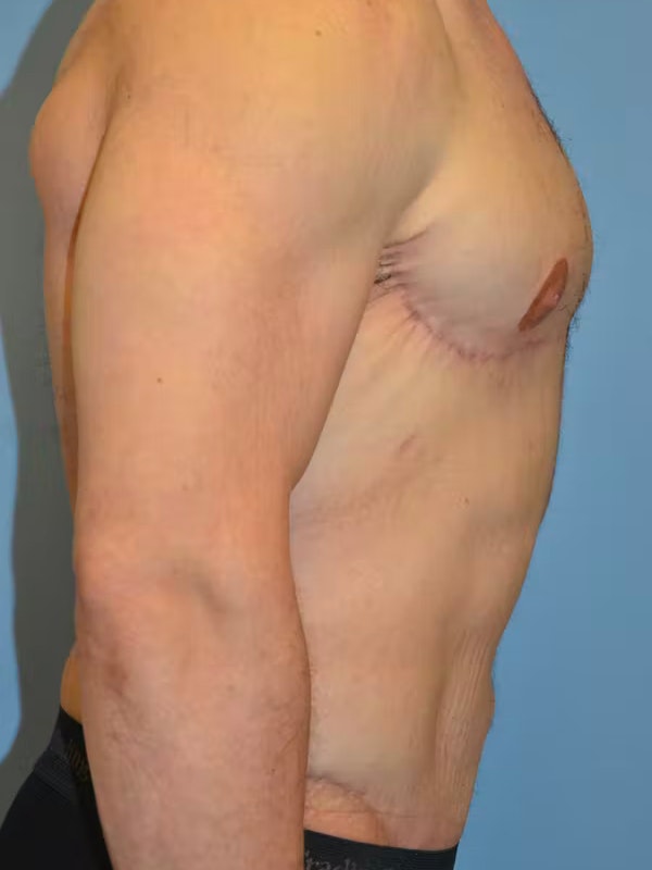 After Weight Loss Surgery Before & After Gallery - Patient 96421936 - Image 8