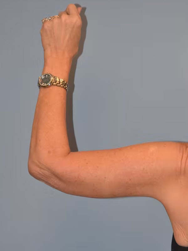Arm Lift Before & After Gallery - Patient 26332737 - Image 2