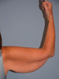 Arm Lift Before & After Gallery - Patient 92151298 - Image 1