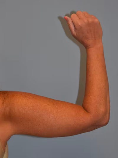 Arm Lift Before & After Gallery - Patient 92151298 - Image 2