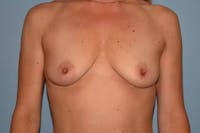 Breast Augmentation Before & After Gallery - Patient 40626583 - Image 1