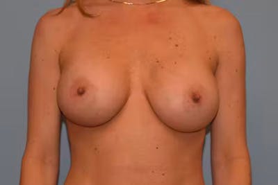 Breast Augmentation Before & After Gallery - Patient 40626583 - Image 2