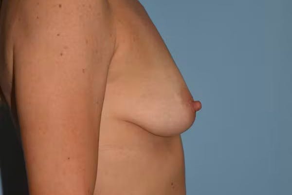 Breast Augmentation Gallery - Patient 40626583 - Image 5
