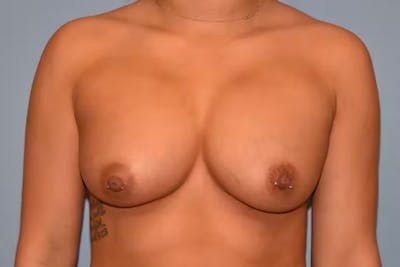Breast Augmentation Before & After Gallery - Patient 92151733 - Image 2