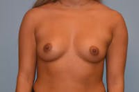 Breast Augmentation Gallery - Patient 92151798 - Image 1