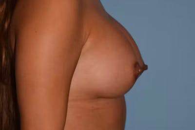 Breast Augmentation Before & After Gallery - Patient 92151798 - Image 6