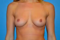 Breast Augmentation Before & After Gallery - Patient 92167371 - Image 1