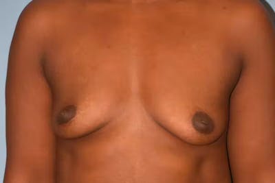 Breast Augmentation Before & After Gallery - Patient 92168129 - Image 1