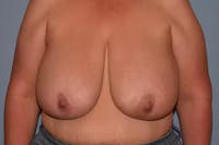 Breast Reduction Before & After Gallery - Patient 26333541 - Image 1