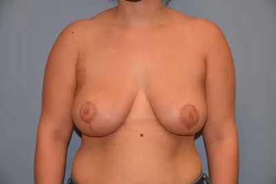 Breast Reduction Before & After Gallery - Patient 40626223 - Image 2