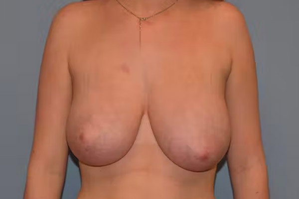 Breast Reduction Before & After Gallery - Patient 40632300 - Image 1