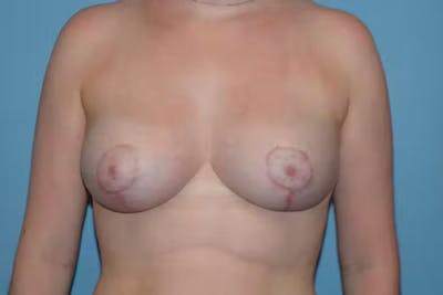 Breast Reduction Before & After Gallery - Patient 40632300 - Image 2