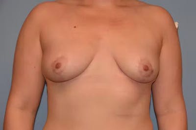 Breast Reduction Before & After Gallery - Patient 92150714 - Image 2