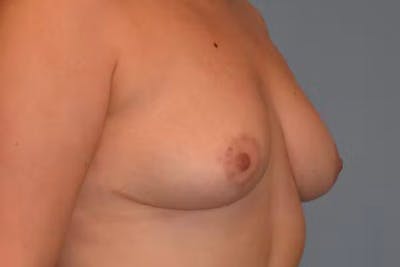 Breast Reduction Before & After Gallery - Patient 92150714 - Image 4
