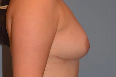 Breast Reduction Before & After Gallery - Patient 92150714 - Image 6