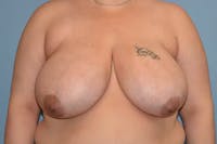 Breast Reduction Before & After Gallery - Patient 92151796 - Image 1