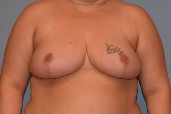 Breast Reduction Before & After Gallery - Patient 92151796 - Image 2