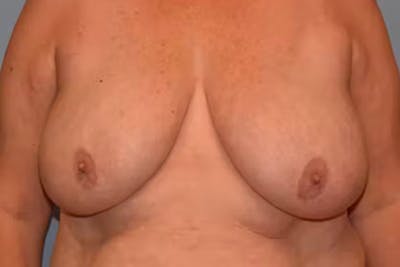 Breast Reduction Gallery - Patient 92167446 - Image 1