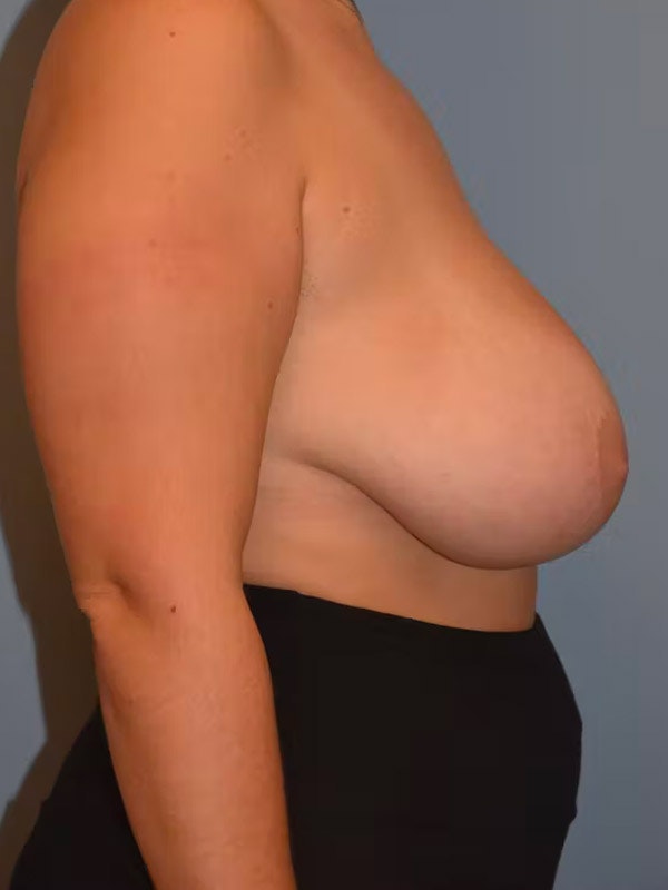 Breast Reduction Before & After Gallery - Patient 96421721 - Image 5
