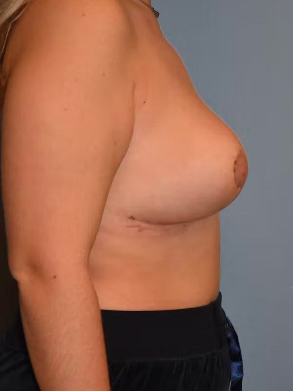 Breast Reduction Before & After Gallery - Patient 96421721 - Image 6