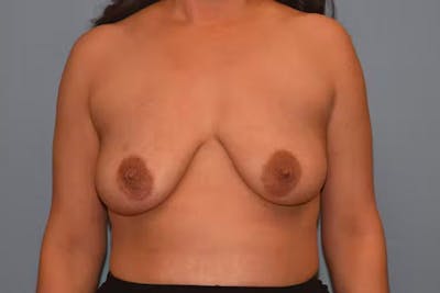 Breast Augmentation Lift Before & After Gallery - Patient 40632060 - Image 1