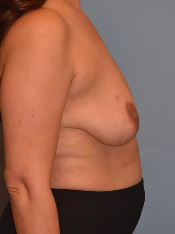Breast Augmentation Lift Before & After Gallery - Patient 40632060 - Image 5