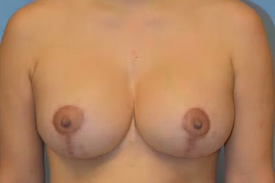 Breast Augmentation Lift Before & After Gallery - Patient 92167548 - Image 2