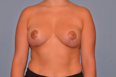 Breast Lift Before & After Gallery - Patient 40626206 - Image 2