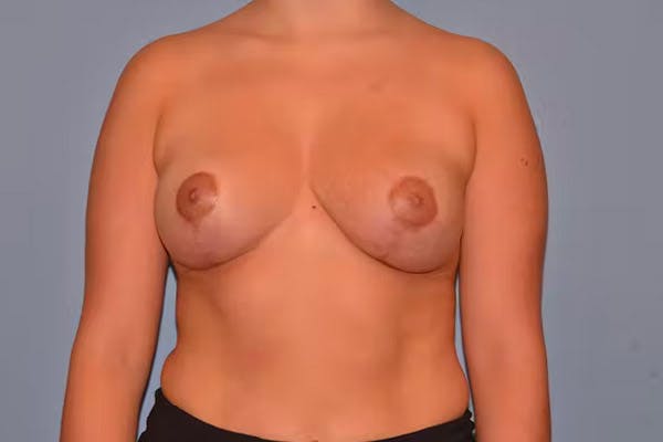 Breast Lift Gallery - Patient 40626206 - Image 2
