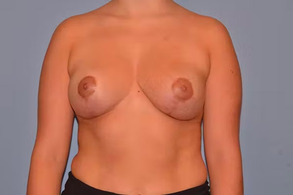Breast Lift Before & After Gallery - Patient 40626206 - Image 2