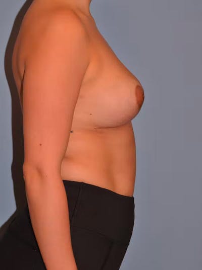 Breast Lift Before & After Gallery - Patient 40626206 - Image 6