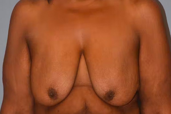 Breast Lift Before & After Gallery - Patient 92151762 - Image 1
