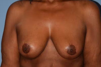Breast Lift Gallery - Patient 92151762 - Image 2