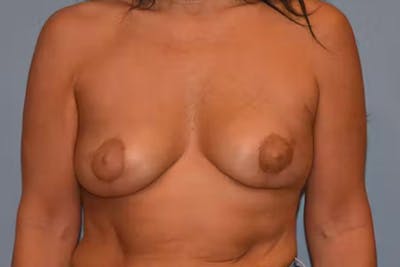 Breast Reconstruction Before & After Gallery - Patient 92151657 - Image 2