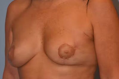 Breast Reconstruction Before & After Gallery - Patient 92151657 - Image 4