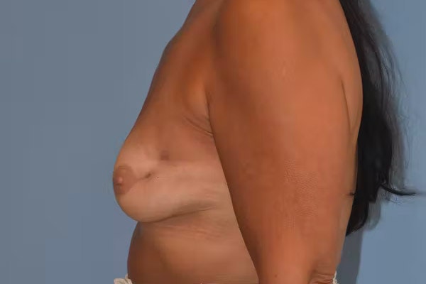 Breast Reconstruction Before & After Gallery - Patient 92151657 - Image 5