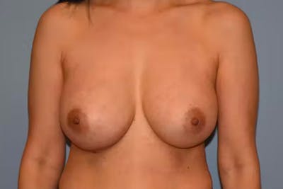 Breast Implant Removal Before & After Gallery - Patient 92167427 - Image 1