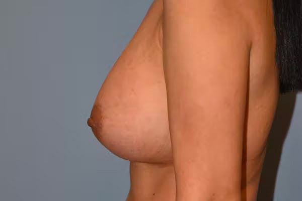 Breast Implant Removal Gallery - Patient 92167427 - Image 5