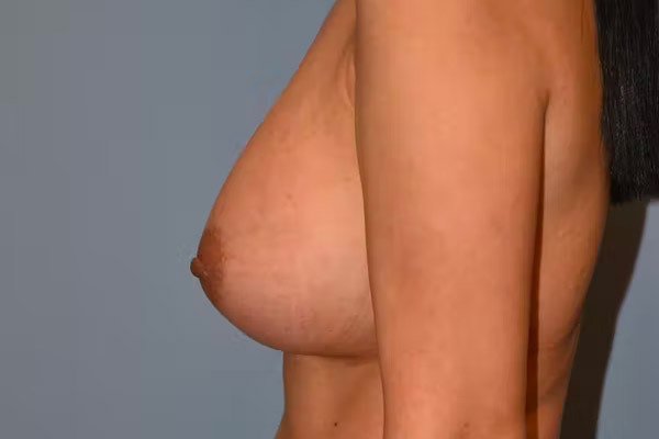 Breast Implant Removal Before & After Gallery - Patient 92167427 - Image 5