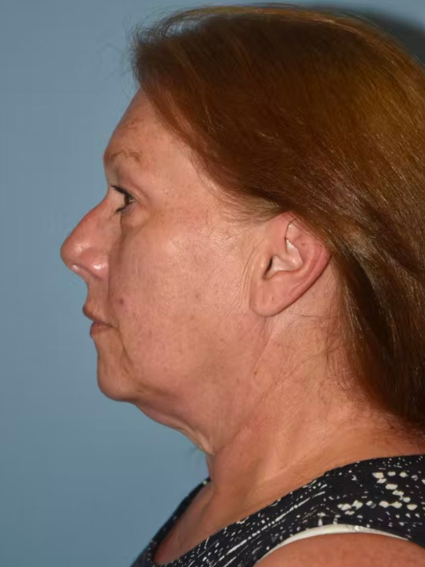 Facelift Before & After Gallery - Patient 26333364 - Image 5