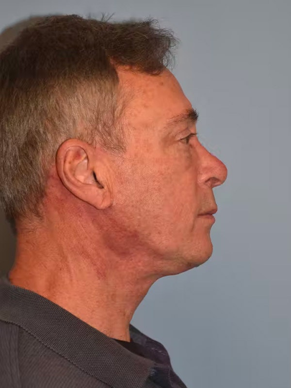 Facelift Before & After Gallery - Patient 40632172 - Image 6