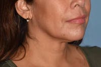 Facelift Before & After Gallery - Patient 92151569 - Image 1
