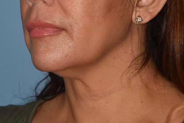 Facelift Before & After Gallery - Patient 92151569 - Image 3