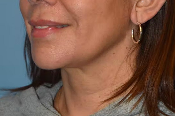 Facelift Before & After Gallery - Patient 92151569 - Image 4